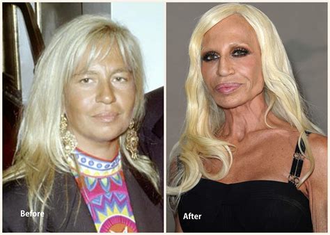 donatella versace lips|Donatella Versace Before and After Plastic Surgery .